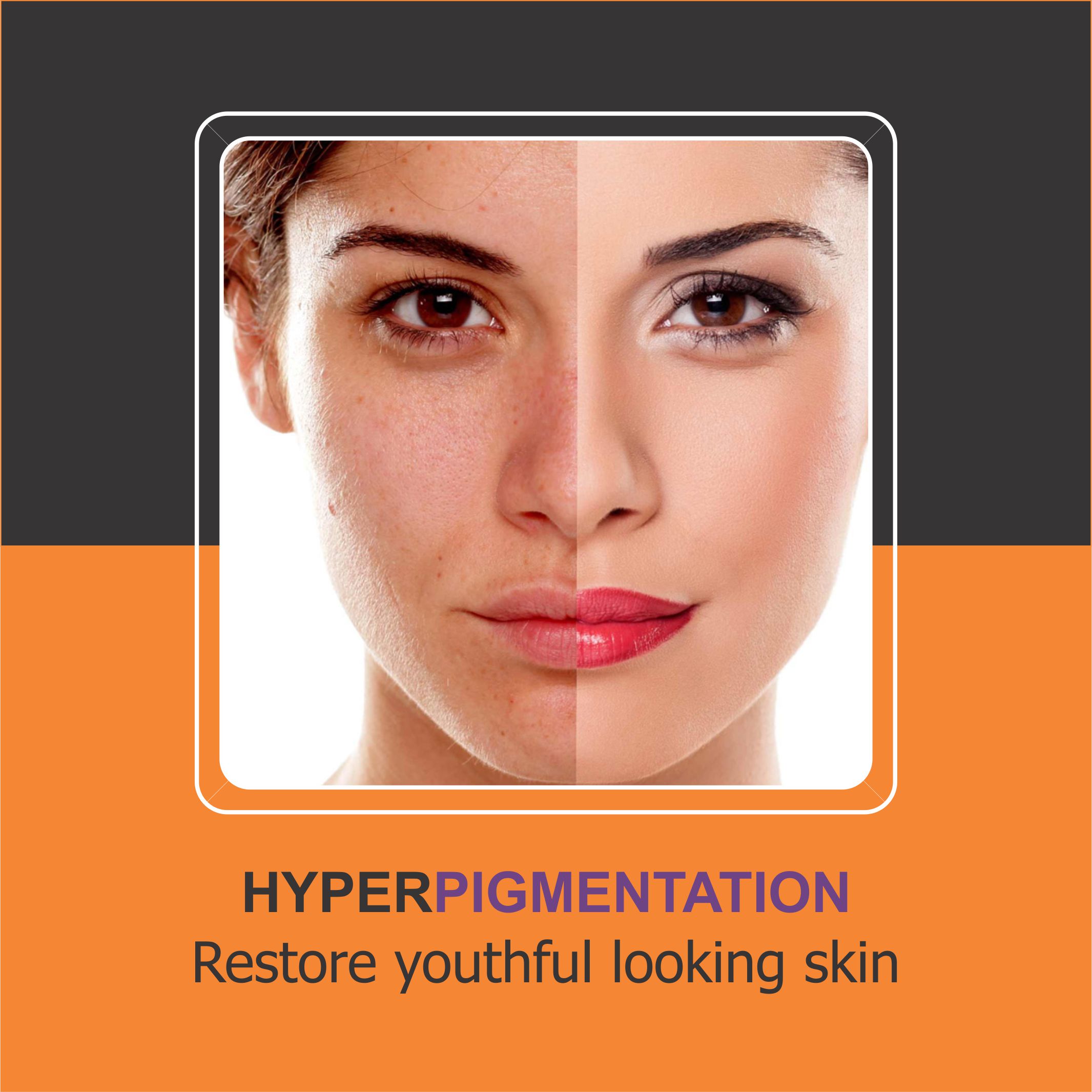 Hyperpigmentation