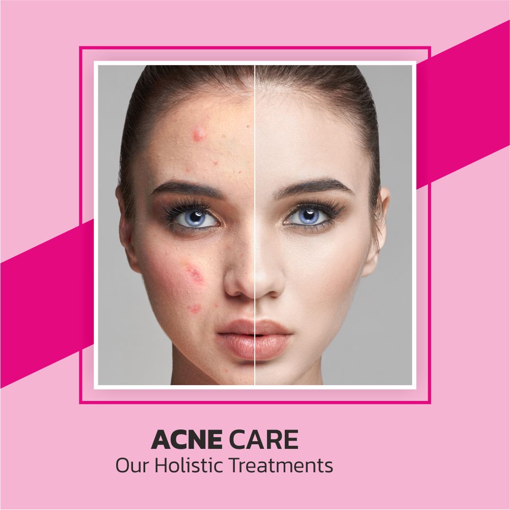 Acne Care